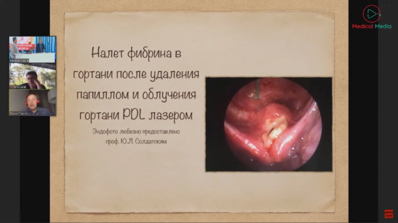 23 апреля состоялся международный вебинар о папилломатозе гортани 5