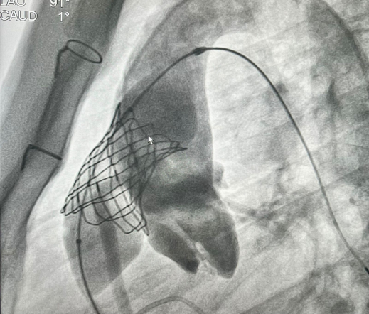 Врачи Педиатрического университета выполнили рентгенэндоваскулярную имплантацию клапана лёгочной артерии 14-летнему пациенту из Луганска 1