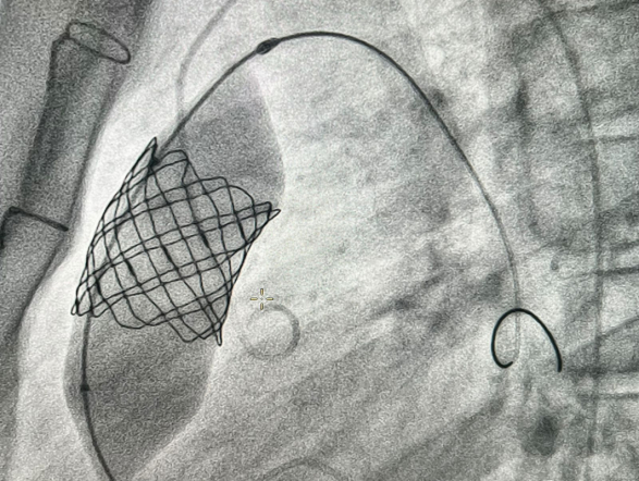 Врачи Педиатрического университета выполнили рентгенэндоваскулярную имплантацию клапана лёгочной артерии 14-летнему пациенту из Луганска 2