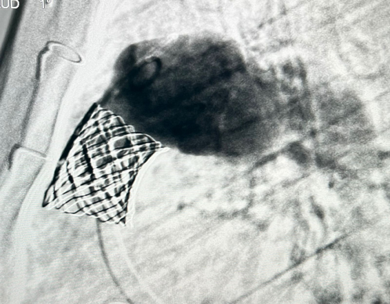 Врачи Педиатрического университета выполнили рентгенэндоваскулярную имплантацию клапана лёгочной артерии 14-летнему пациенту из Луганска 4