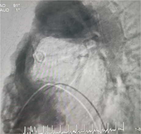 Врачи Педиатрического университета выполнили рентгенэндоваскулярную имплантацию клапана лёгочной артерии 14-летнему пациенту из Луганска 10