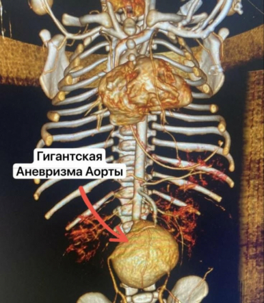 Врачи Педиатрического университета выполнили операцию новорождённому ребёнку с гигантской врождённой аневризмой аорты 3