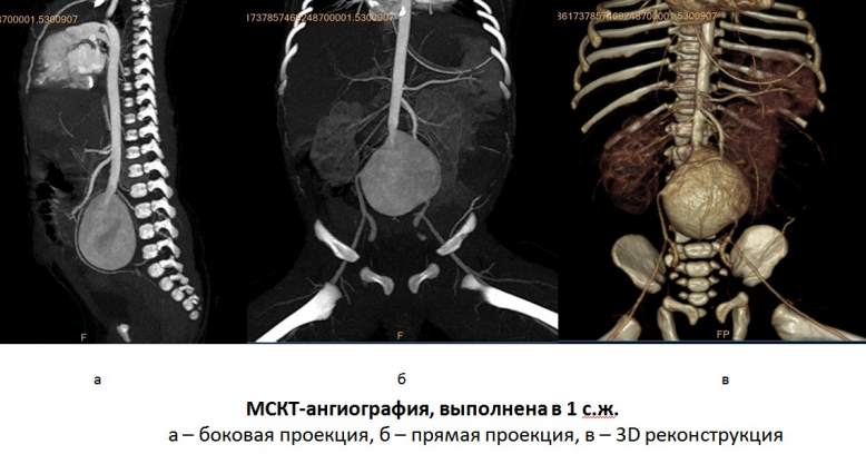 Врачи Педиатрического университета выполнили операцию новорождённому ребёнку с гигантской врождённой аневризмой аорты 4