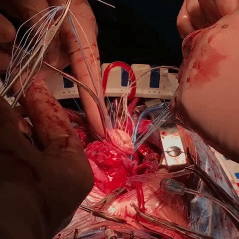 В некоторых случаях пациенты могут нуждаться в пластике или протезировании клапанов.